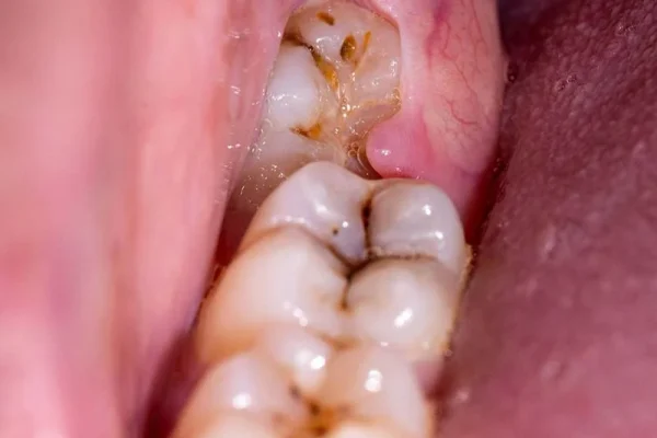 Wisdom Of Teeth