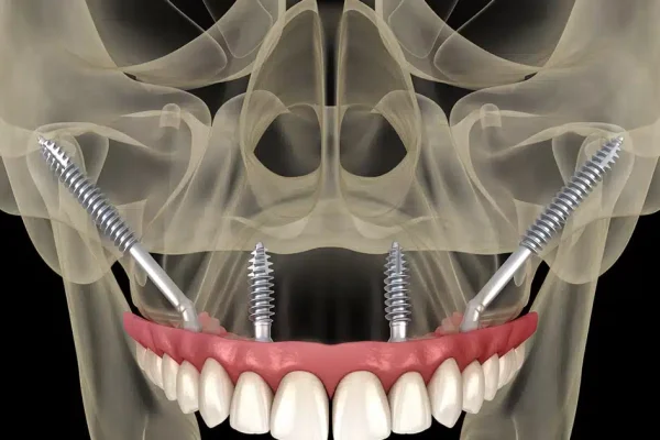 Zygomatic Implants
