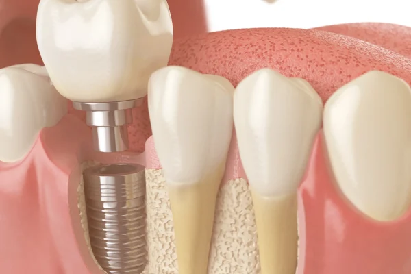 bone grafting for dental implants