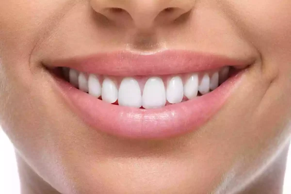 composite veneers3