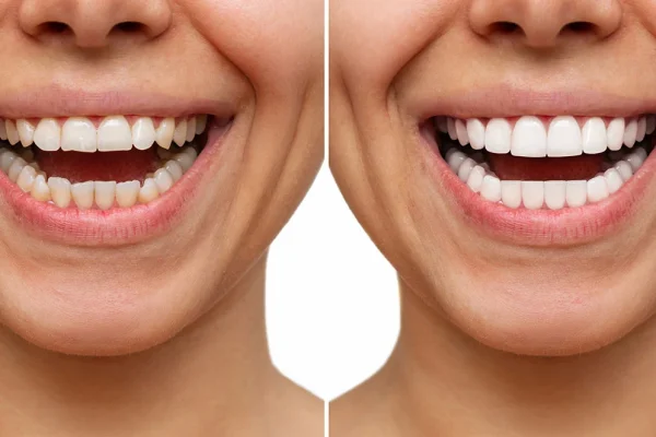 dental reshaping