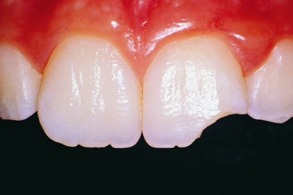 dental trauma guidelines
