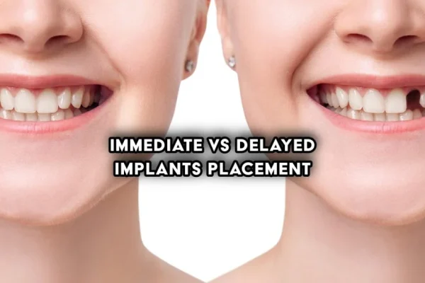 immediate loading vs delayed loading implants