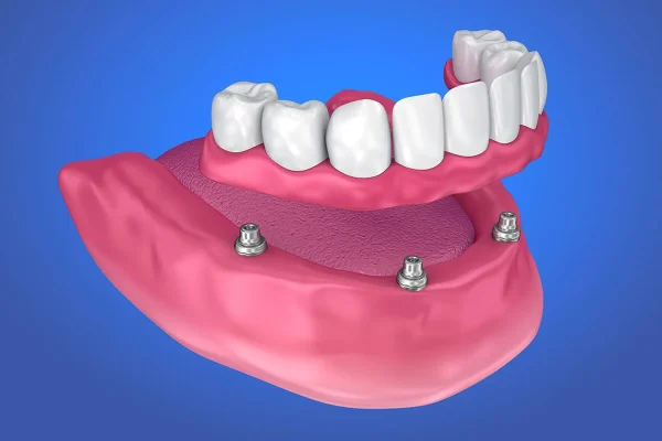 implant supported dentures