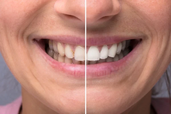 metodo naturale per sbiancare i denti