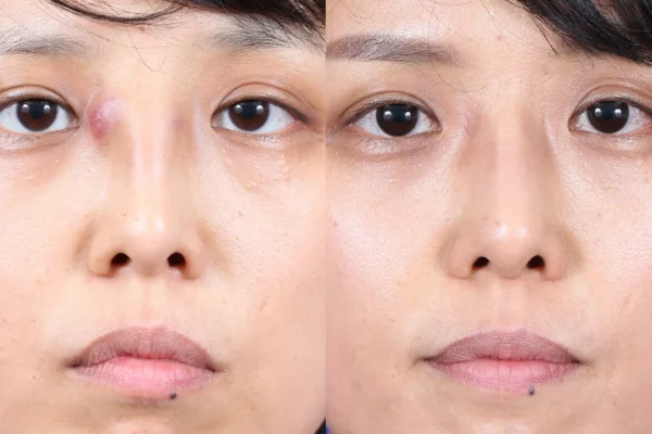 nasal implants