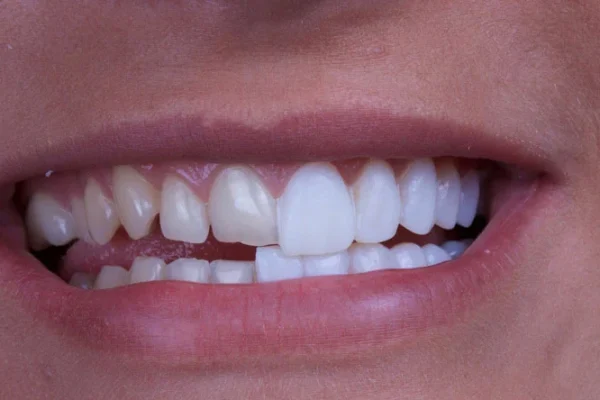 porcelain veneers
