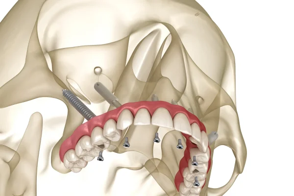 pterygoid dental implants