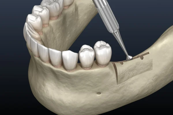 ridge augmentation