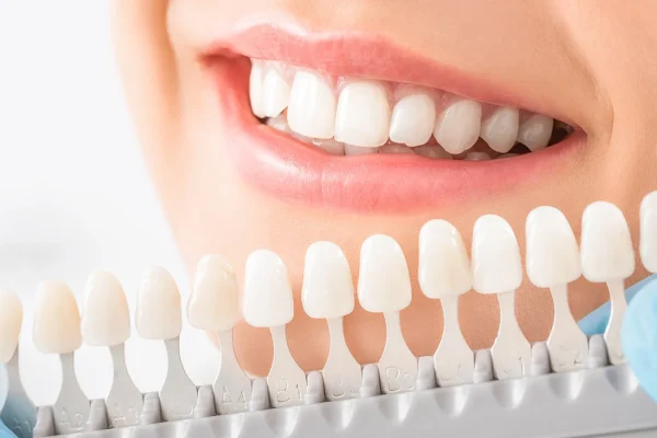 sbiancamento dentale1