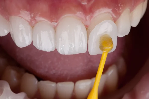 Veneers price UK