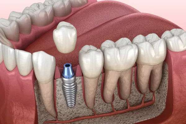 single tooth implant