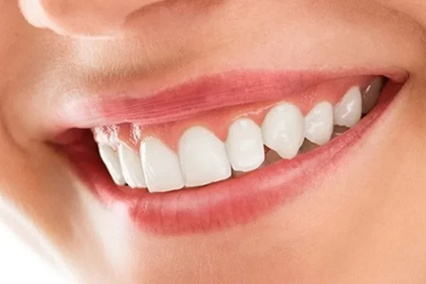smile makeover4