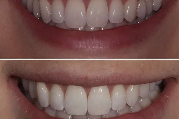 teeth filing